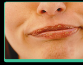 从“嘴起皮”到“慢性唇炎”，90%的人都是被这个小动作害的
