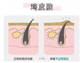 鸡皮肤是如何引起的，正确处理鸡皮肤的方法，从粗糙到光滑
