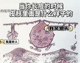 皮肤爆痘留印又留坑的真相